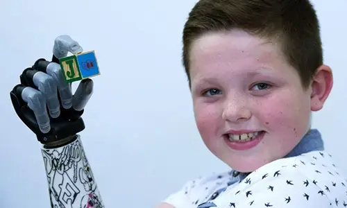 pediatric upper extremity prosthetic